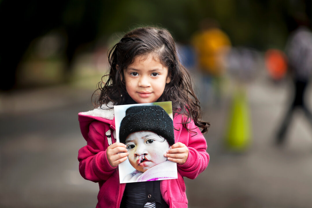 Alexandri, three years after cleft surgery. Photo: Carlos Rueda