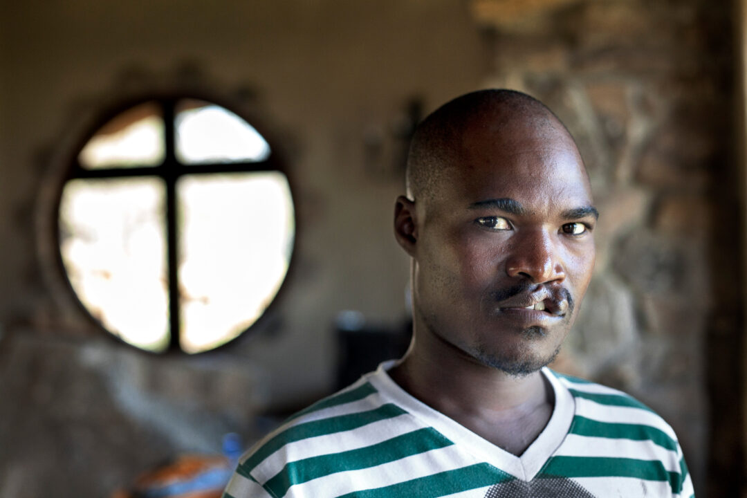 31-year old adult with cleft