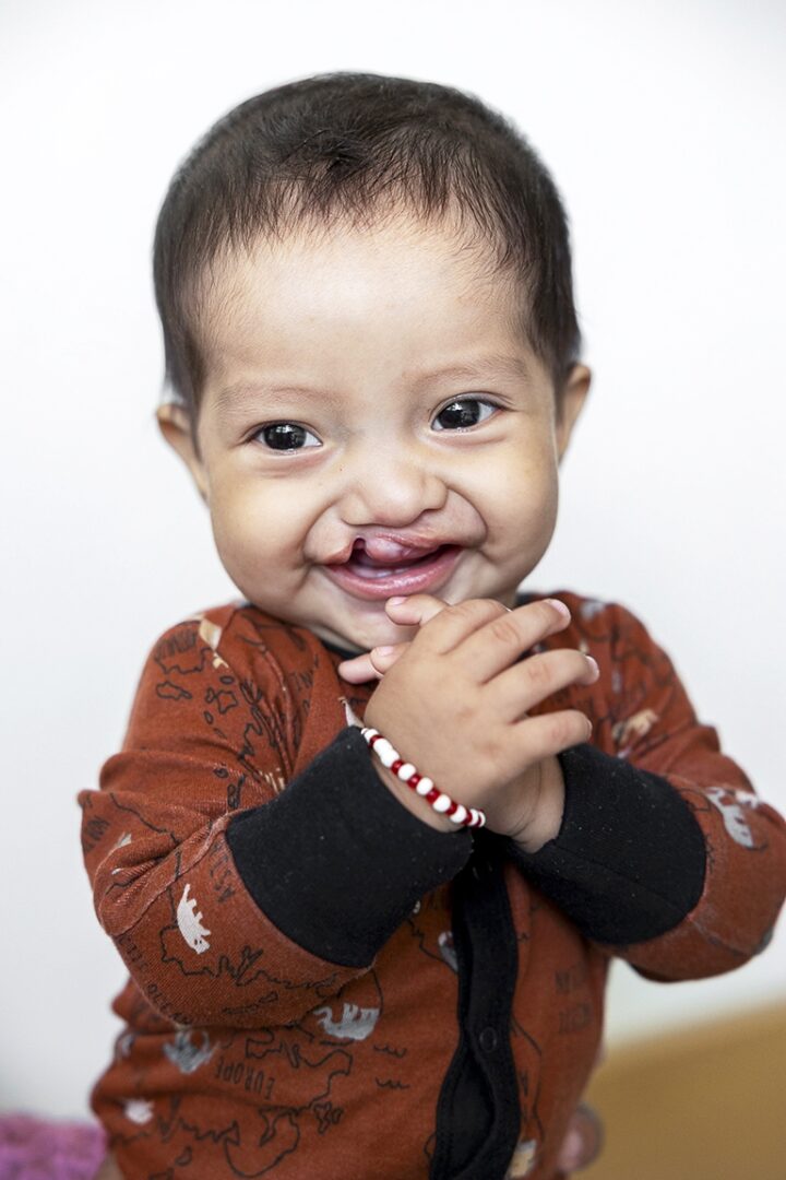 Meet seven-month-old Edwin. Two days before the surgical programme in Escuintla, the lives of Edwin’s parents, Rosemary and José, changed completely after they discovered for the first time that surgery for their son’s cleft condition was possible. Photo: Lorenzo Monacelli.