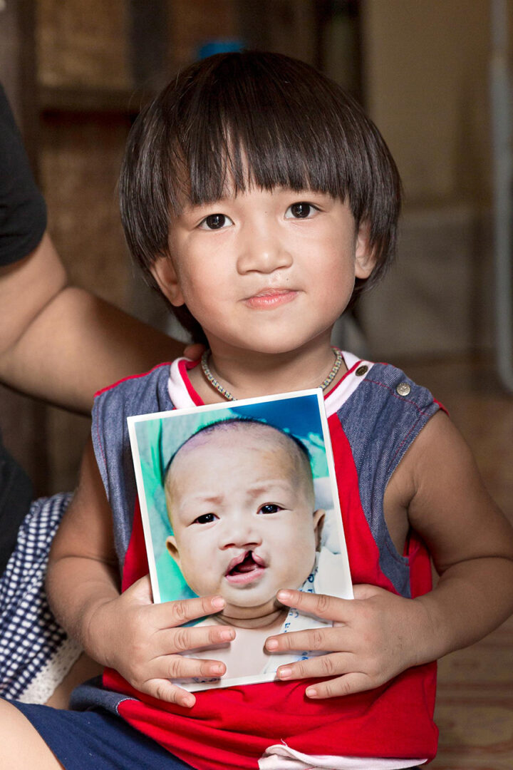 A three-year-old boy smiles, holding a photo of himself as a baby before cleft lip surgery.